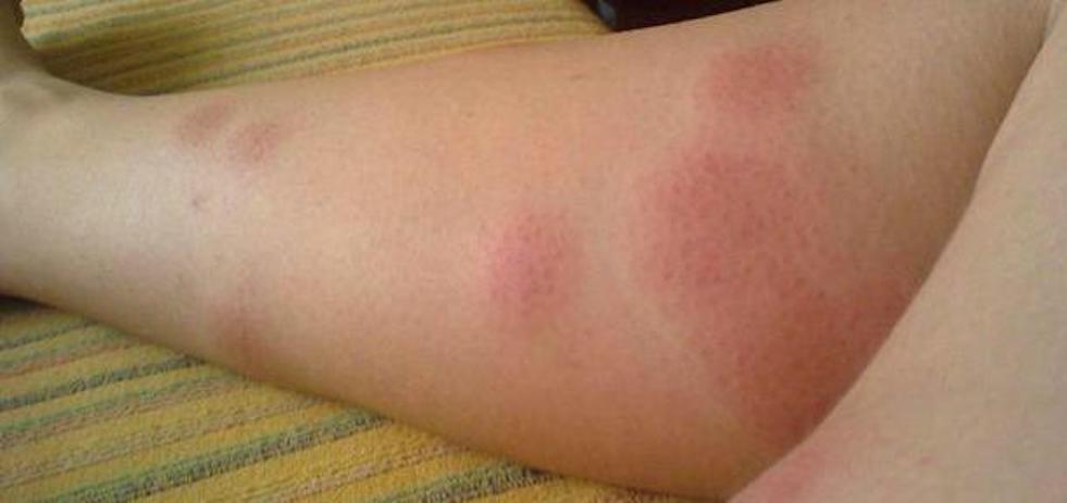 Un afectado por picaduras de mosquistos en Maspalomas | MASPALOMAS AHORA