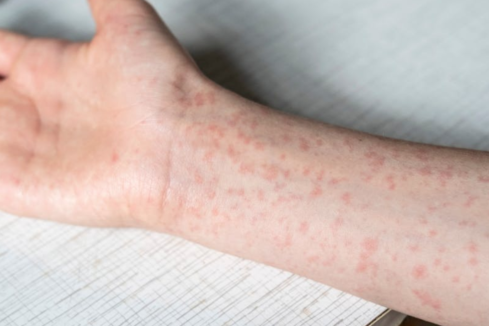 Brazo de un adolescente con las típicas lesiones causadas por el sarampión. Natalya_Maisheva/Shutterstock