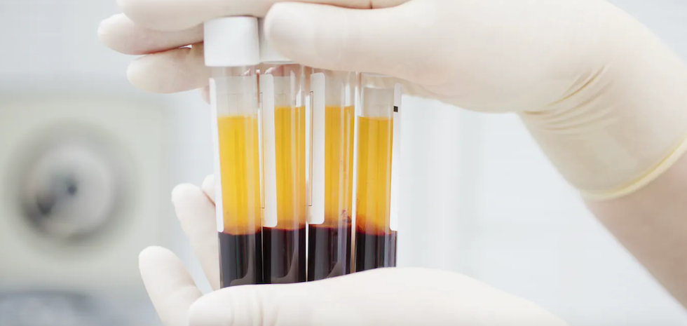 Tubos de sangre en dos capas &ndash;gl&oacute;bulos abajo y plasma plaquetario arriba&ndash; tras pasar por una centrifugadora. Shutterstock / Iryna Kalamurza