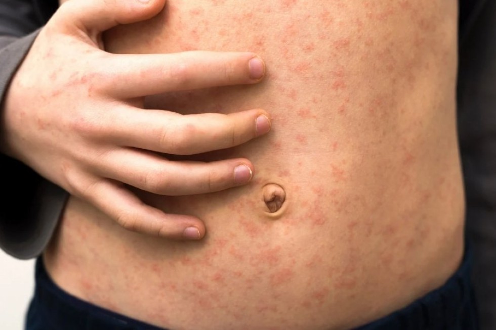 Erupción cutánea (sarampión) | Maspalomas Ahora